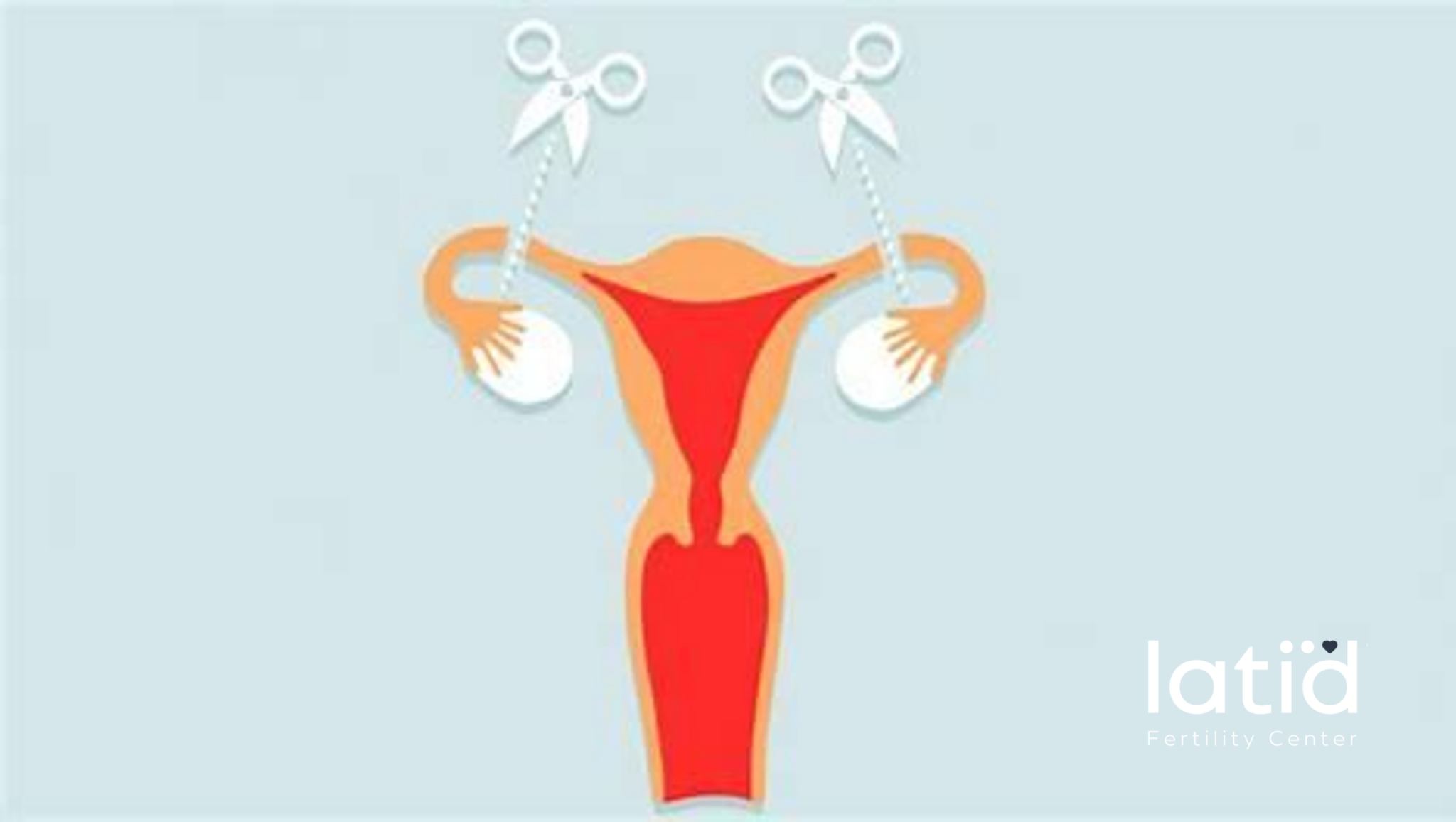 ¿PUEDO SER MADRE DESPUÉS DE UNA LIGADURA DE TROMPAS? Latid Fertility